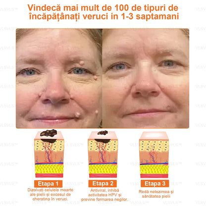 VLSVLS™ CREMĂ DE REPARARE A PIELII CU VENIN DE ALBINĂ (🧑‍⚕️Recomandat de AAD) - Veninul de albine curăță pielea, luptă împotriva acneei, uniformizează tonul pielii, estompează cicatricile, daunele solare și petele de vârstă